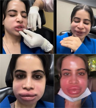 Urfi Javed Shows Off Swollen Face After Dissolving Lip Fillers